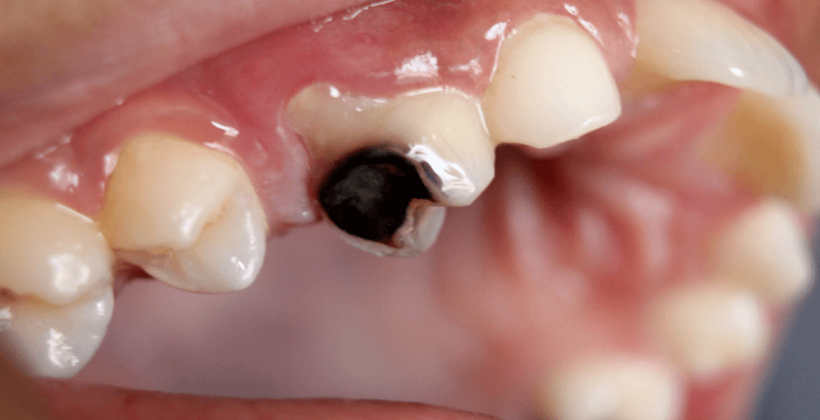 Is Dental Filling Necessary?