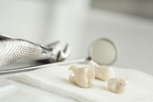 Things You Need to Know About Pericoronitis and Wisdom Teeth