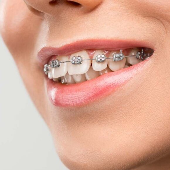 A Stronger Smile in a Shorter Time: The Benefits of Traditional Metal Braces