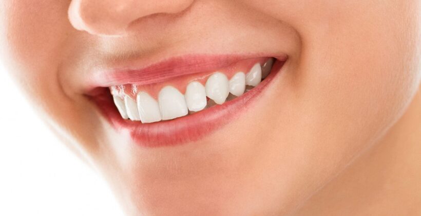 Do You Want To Achieve The Perfect Smile? Dental Veneers May Be The Answer!