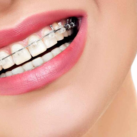 Get The Picture-Perfect Smile With Braces!