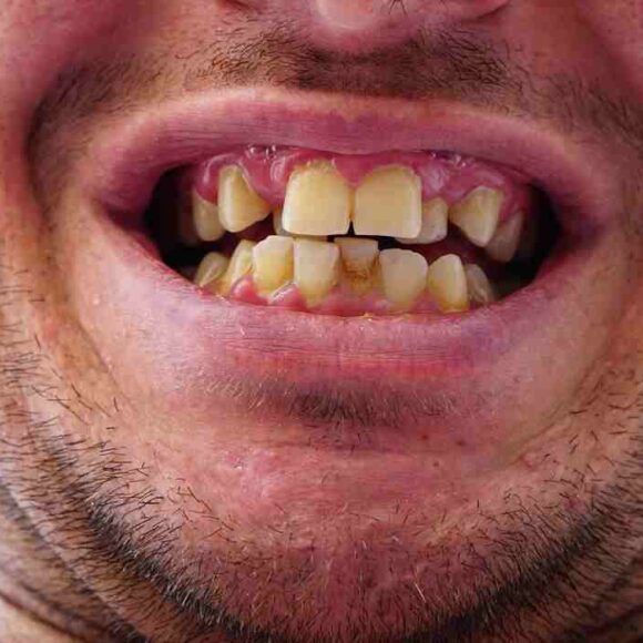 Crooked Teeth – Causes and Treatment