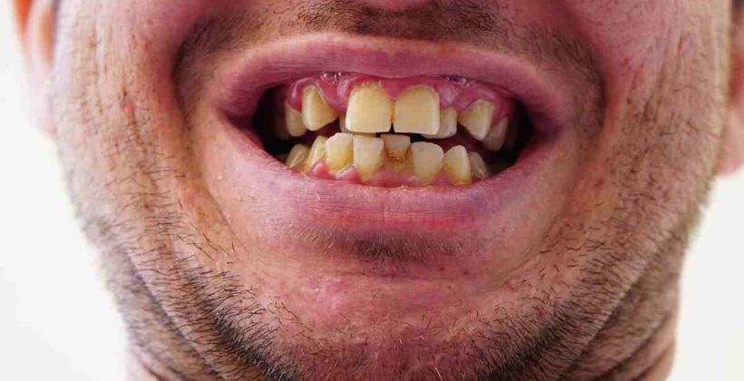 Crooked Teeth – Causes and Treatment
